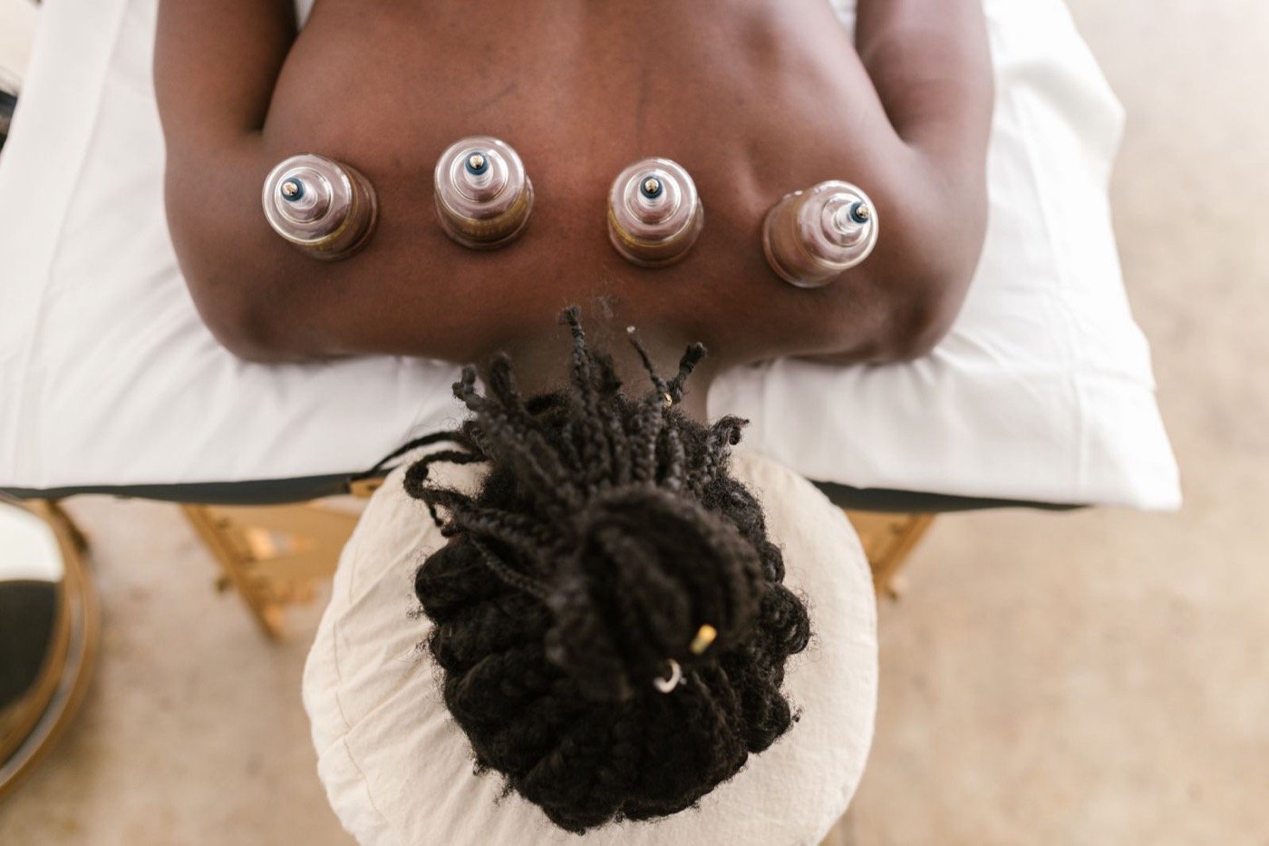 Cupping therapy cups placed along the back during treatment at Plum & Sugar